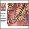 Biliary obstruction - series