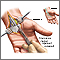 Carpal tunnel surgical procedure