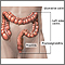 Ulcerative colitis