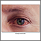 Conjunctivitis