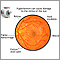 Hypertensive retinopathy