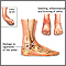 Ankle sprain