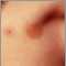 Urticaria pigmentosa in the armpit