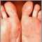 Hand, foot, and mouth disease on the soles