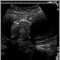 Ultrasound, normal fetus - abdomen measurements