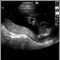 Ultrasound, normal relaxed placenta