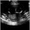 Ultrasound, normal fetus - ventricles of brain