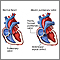 Absent pulmonary valve