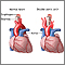 Double aortic arch