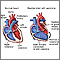 Double inlet left ventricle