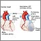 Anomalous left coronary artery