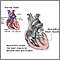 Myocarditis