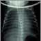 Totally anomalous pulmonary venous return, X-ray