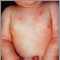 Dermatitis, atopic in an infant