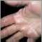 Hyperlinearity in atopic dermatitis, on the palm