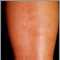 Polyarteritis, microscopic on the shin