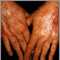 Skin cancer, squamous cell on the hands