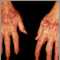 Lichen planus on the hands