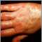 Vasculitis, urticarial on the hand