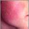 Keratosis pilaris rubra faceii