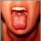 Mononucleosis - mouth