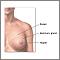 Breast lump removal  - series