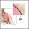 Chest tube insertion  - series