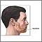 Chin augmentation  - series