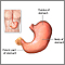 Gastrectomy  - series