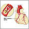 Coronary artery disease