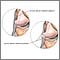 Torn lateral collateral ligament