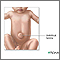 Umbilical hernia