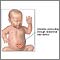 Infant abdominal hernia (gastroschisis)