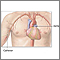 Cardiac arteriogram