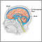 Cerebrospinal fluid leak