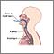 Esophageal pH monitoring