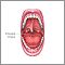 Macroglossia