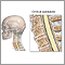 Cervical spondylosis